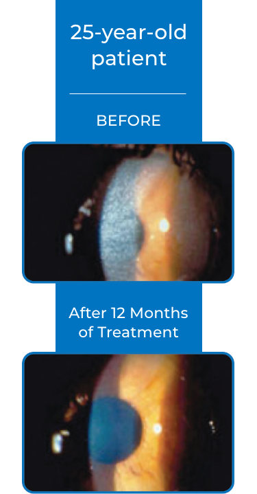 25 year old cystaran patient's cornea before and after treatment