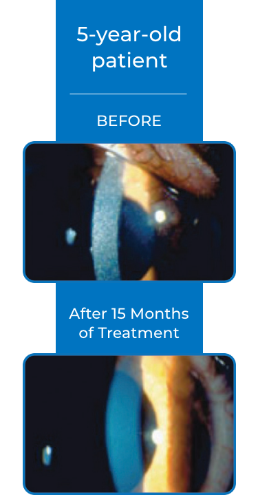 5 year old cystaran patient corneal slit-lamp photo before and after