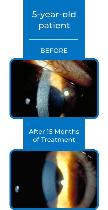 eye cystinosis patients' corneas before and after treatment