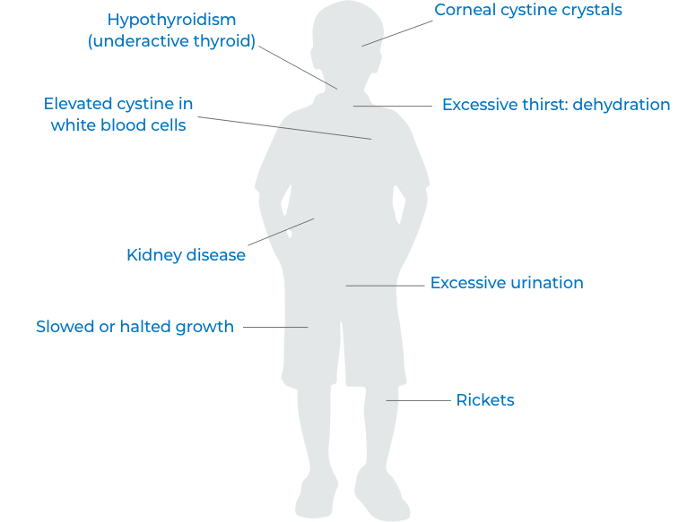 cystinosis symptoms image