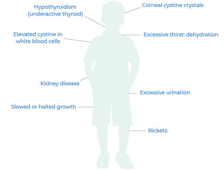 cystinosis symptoms image