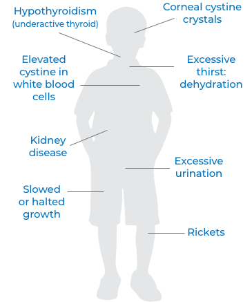 cystinosis symptoms image" title="cystinosis symptoms image