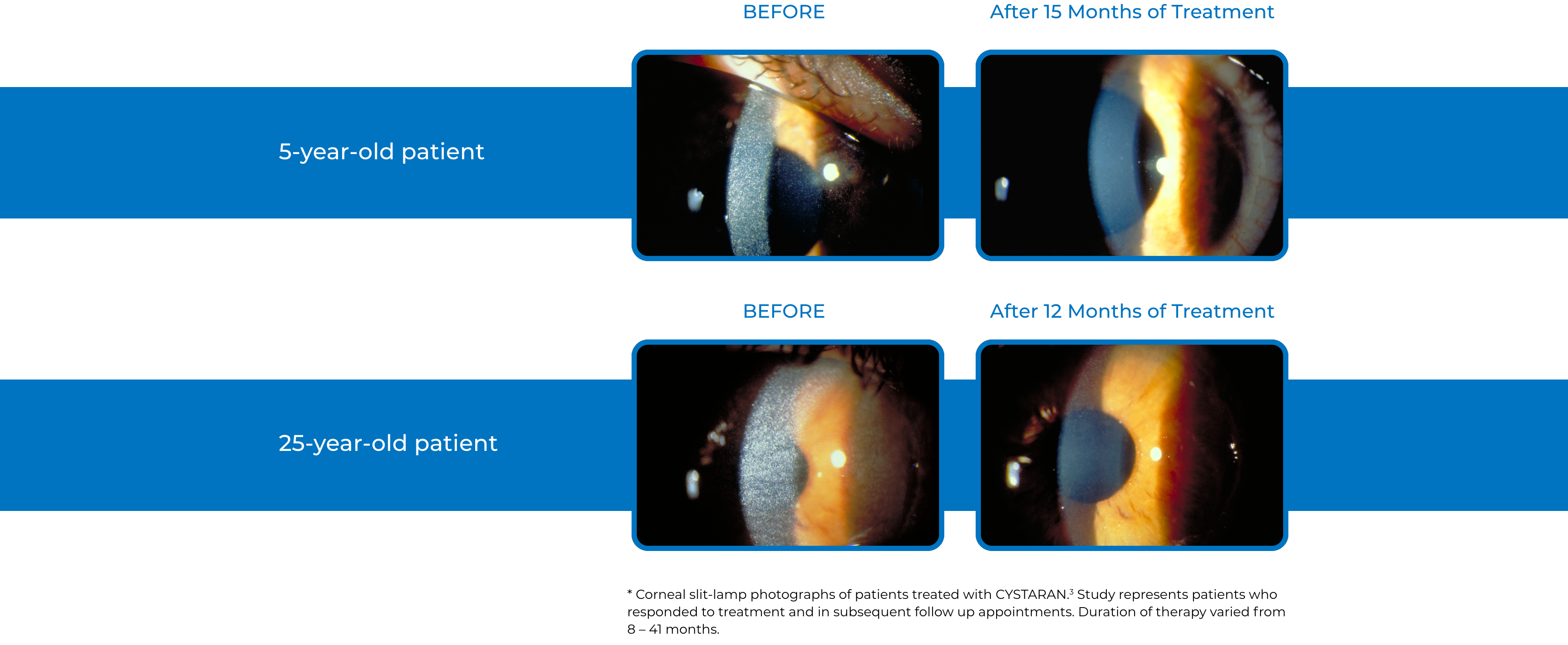corneal slit-lamp photo of cystaran patients