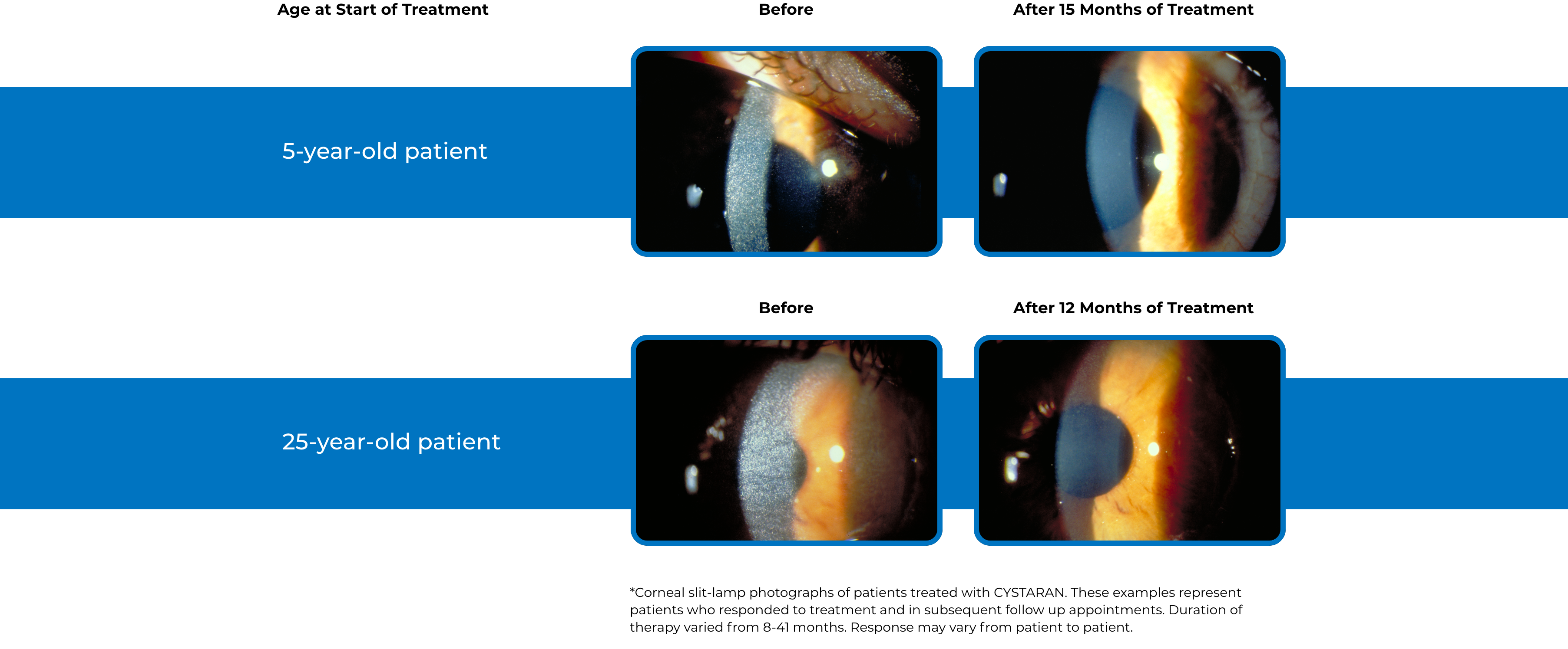 eye cystinosis patients' corneas before and after treatment